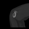 SPORK, NICO - 22.03.1976 - 02.08.2022 - CT obere Extremität - 17:59:07